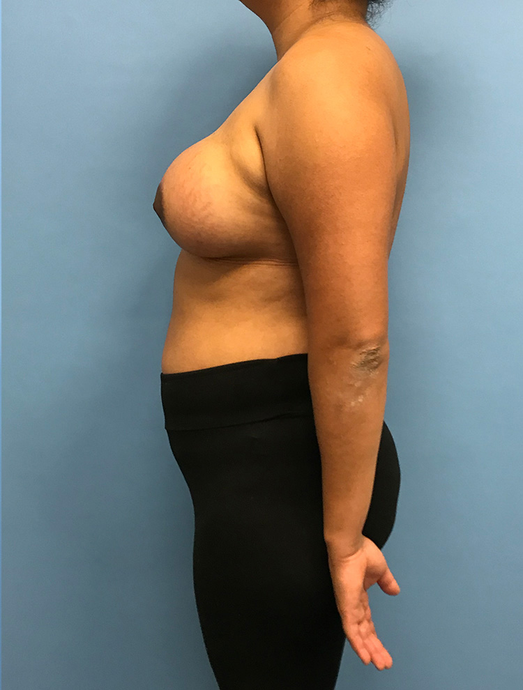 Side view of a woman after tuberous breast correction surgery
