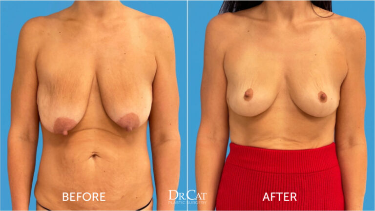 Breast Lift patient results - Dr. Cat Beverly Hills