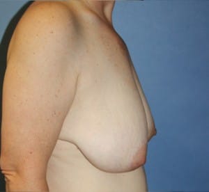 Breast Reduction before photo - Dr. Cat Beverly Hills
