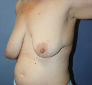Breast Reduction before photo - Dr. Cat Beverly Hills