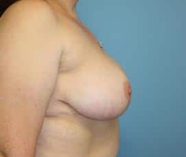 Breast Reduction after photo - Dr. Cat Beverly Hills