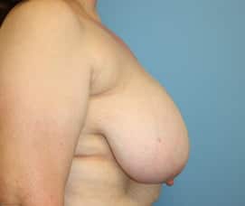 Breast Reduction before photo - Dr. Cat Beverly Hills