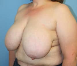 Breast Reduction before photo - Dr. Cat Beverly Hills