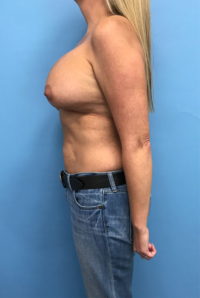 Case BRV-0719 before photo — Dr. Cat, Beverly Hills
