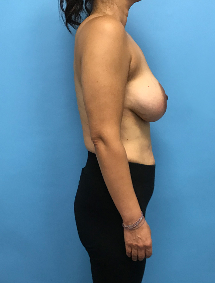 Side view of a woman's chest before breast revision surgery, showing sagging and asymmetry.
