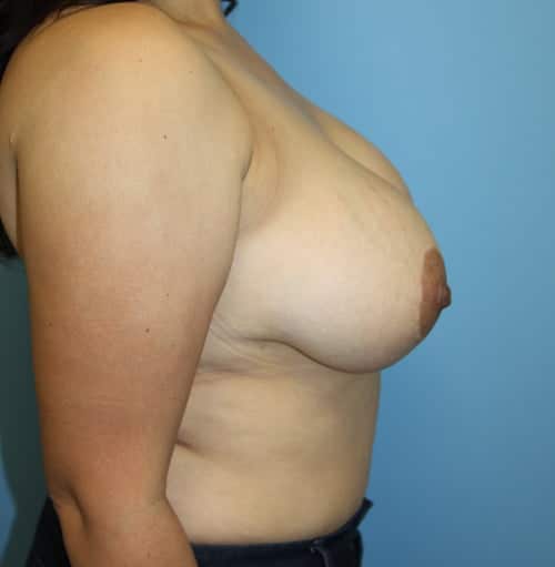 Breast Revision before photo - Dr. Cat Beverly Hills