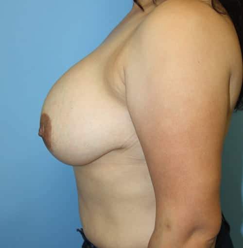 Breast Revision before photo - Dr. Cat Beverly Hills