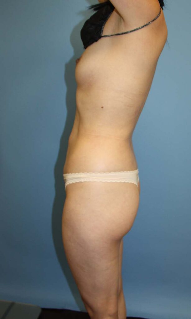 Case BBL-5047 before photo — Dr. Cat, Beverly Hills