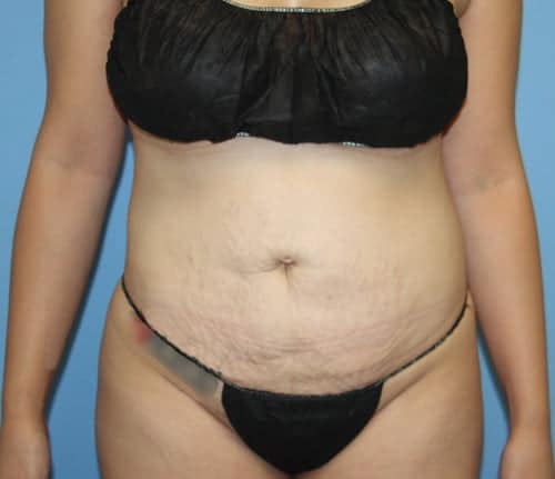 Plastic surgery patient results - Dr. Cat Beverly Hills