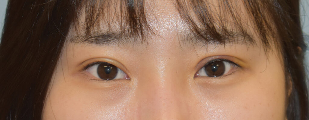 Case ELF-P4 before photo — Dr. Cat, Beverly Hills