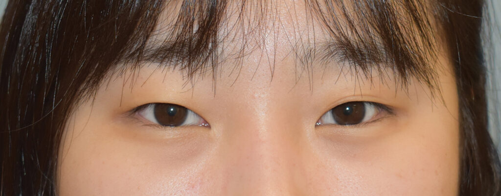 Case ELF-P4 after photo — Dr. Cat, Beverly Hills