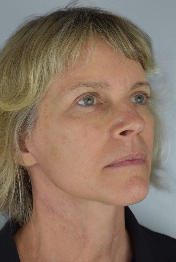 Case FLF-P18 after photo — Dr. Cat, Beverly Hills