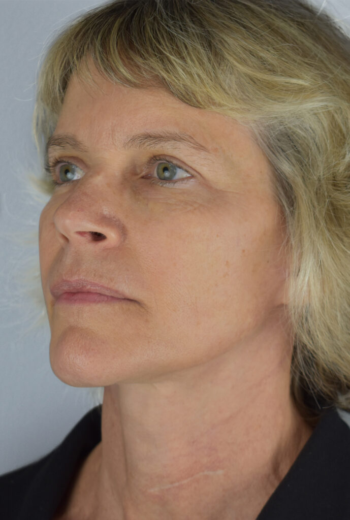 Case FLF-P18 after photo — Dr. Cat, Beverly Hills