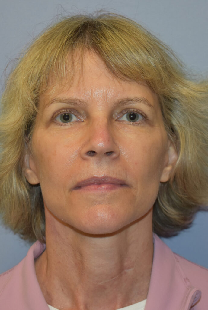 Case FLF-P18 after photo — Dr. Cat, Beverly Hills