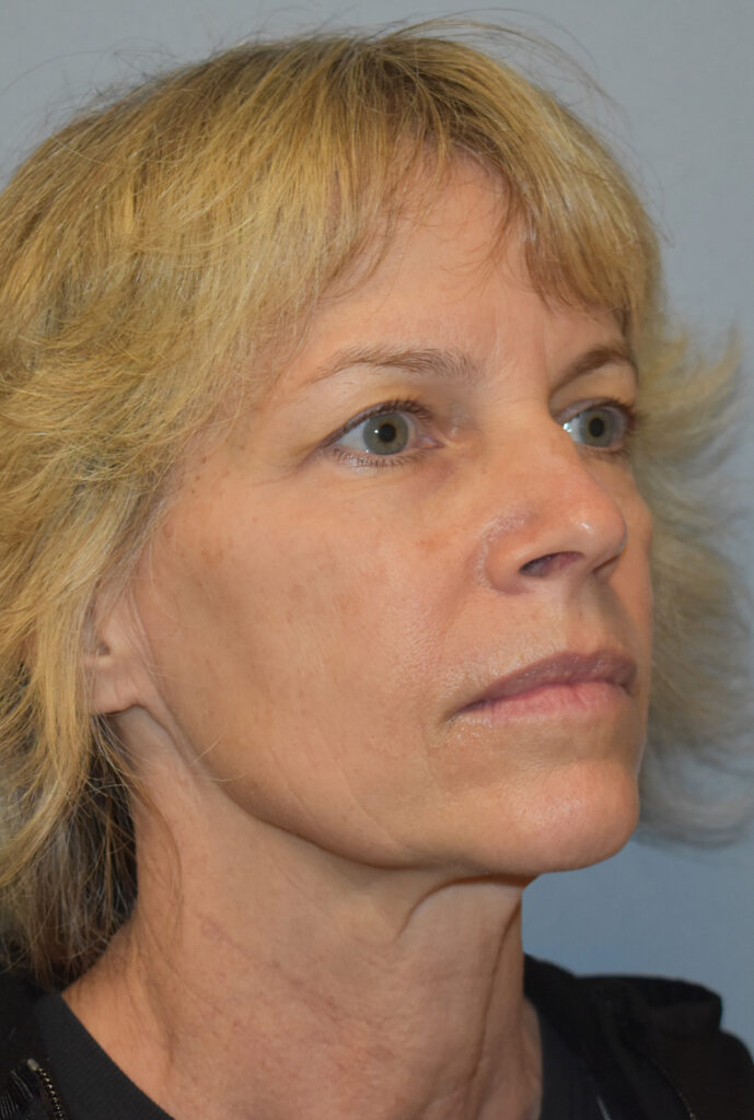 Case FLF-P18 before photo — Dr. Cat, Beverly Hills