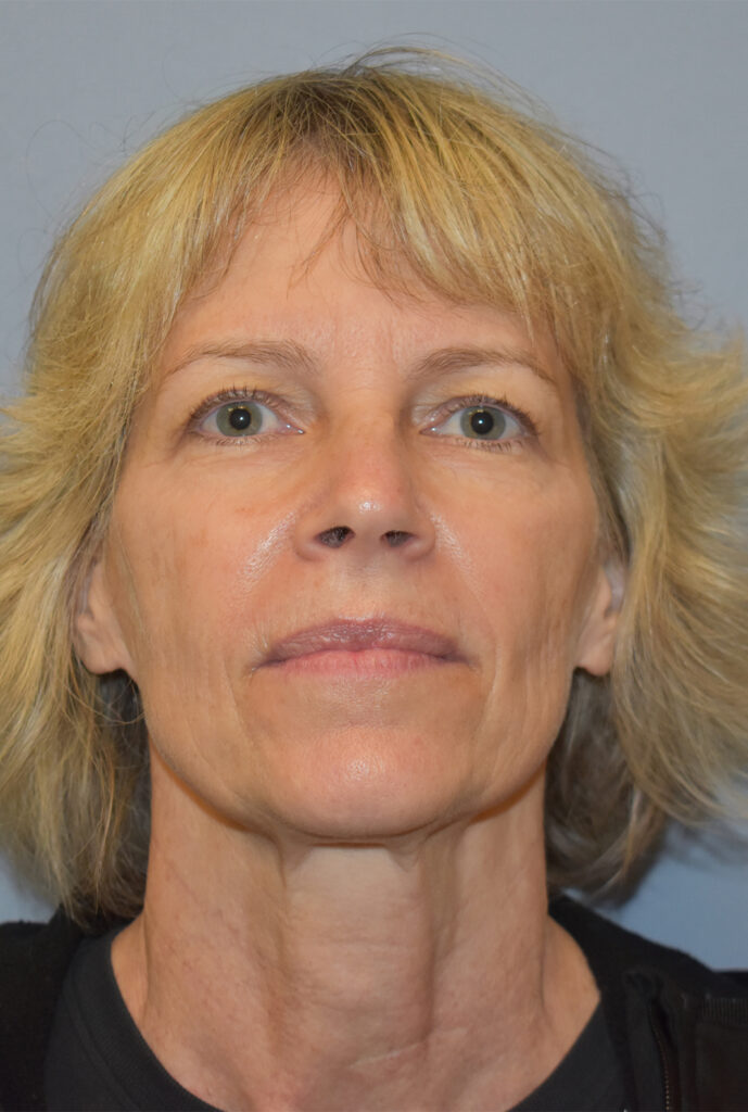 Case FLF-P18 before photo — Dr. Cat, Beverly Hills