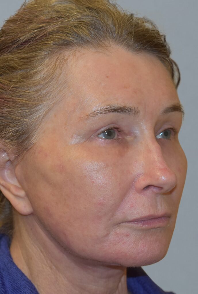 Case FLF-P25 after photo — Dr. Cat, Beverly Hills