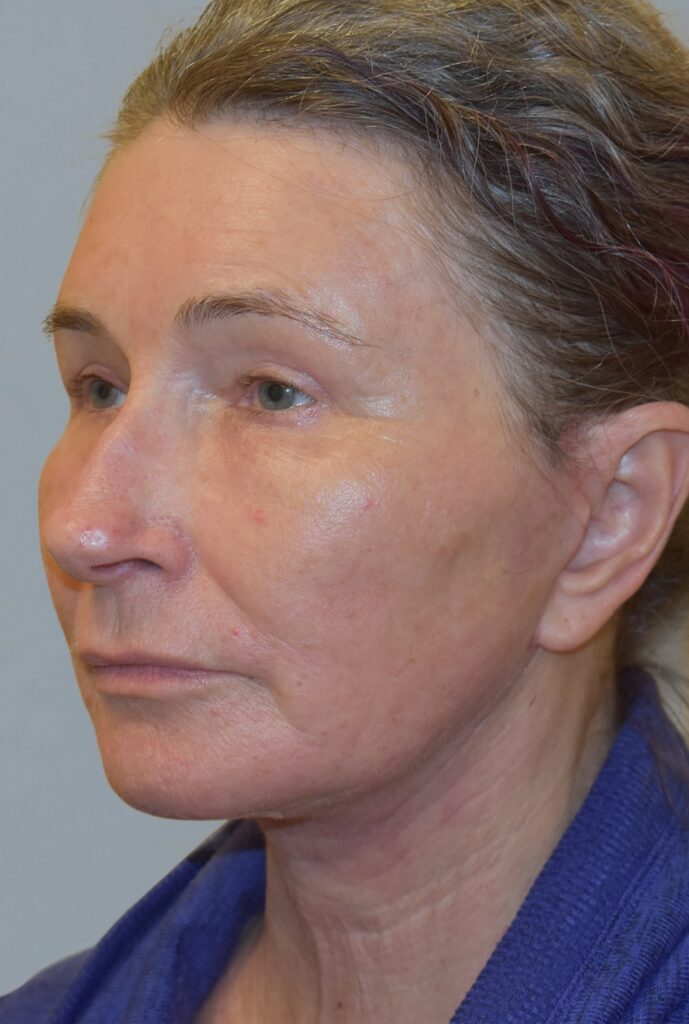 Case FLF-P25 after photo — Dr. Cat, Beverly Hills