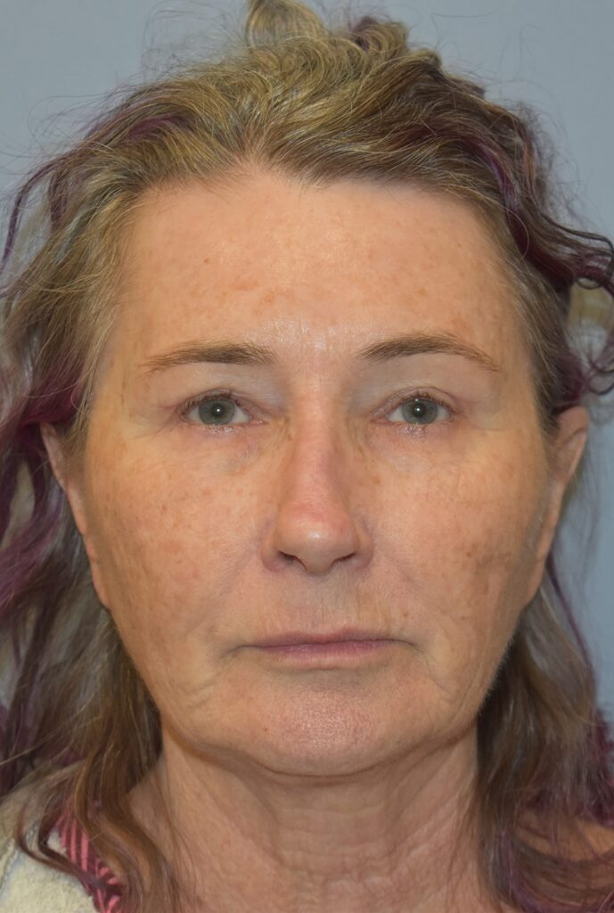 Case FLF-P25 before photo — Dr. Cat, Beverly Hills