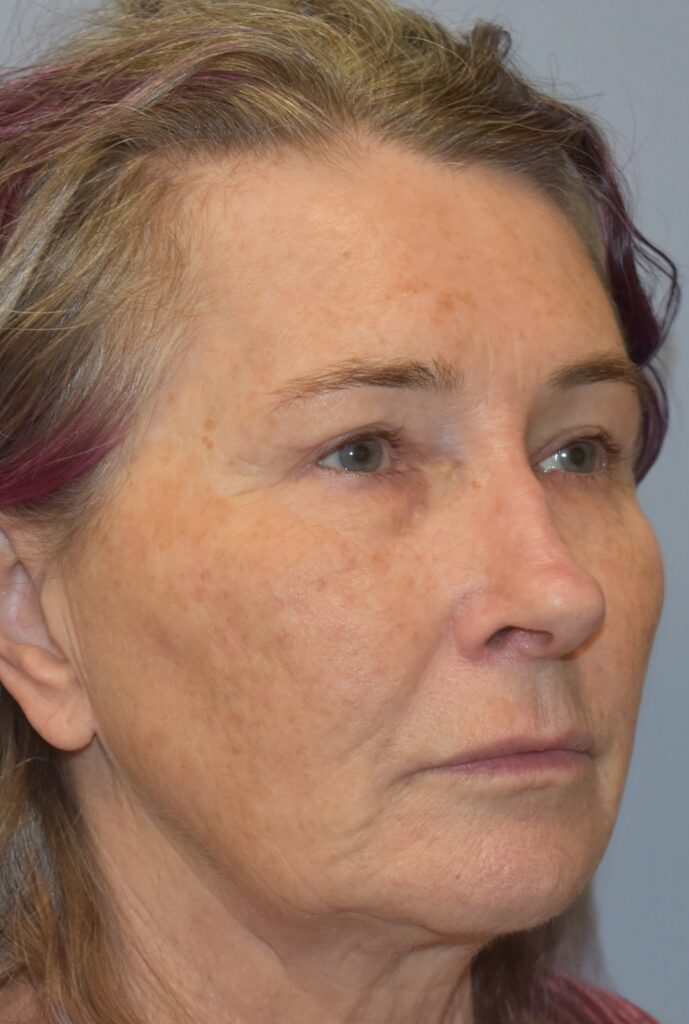 Case FLF-P25 before photo — Dr. Cat, Beverly Hills