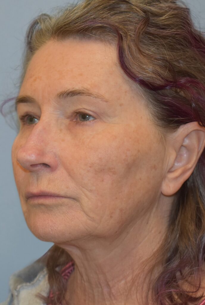 Case FLF-P25 before photo — Dr. Cat, Beverly Hills