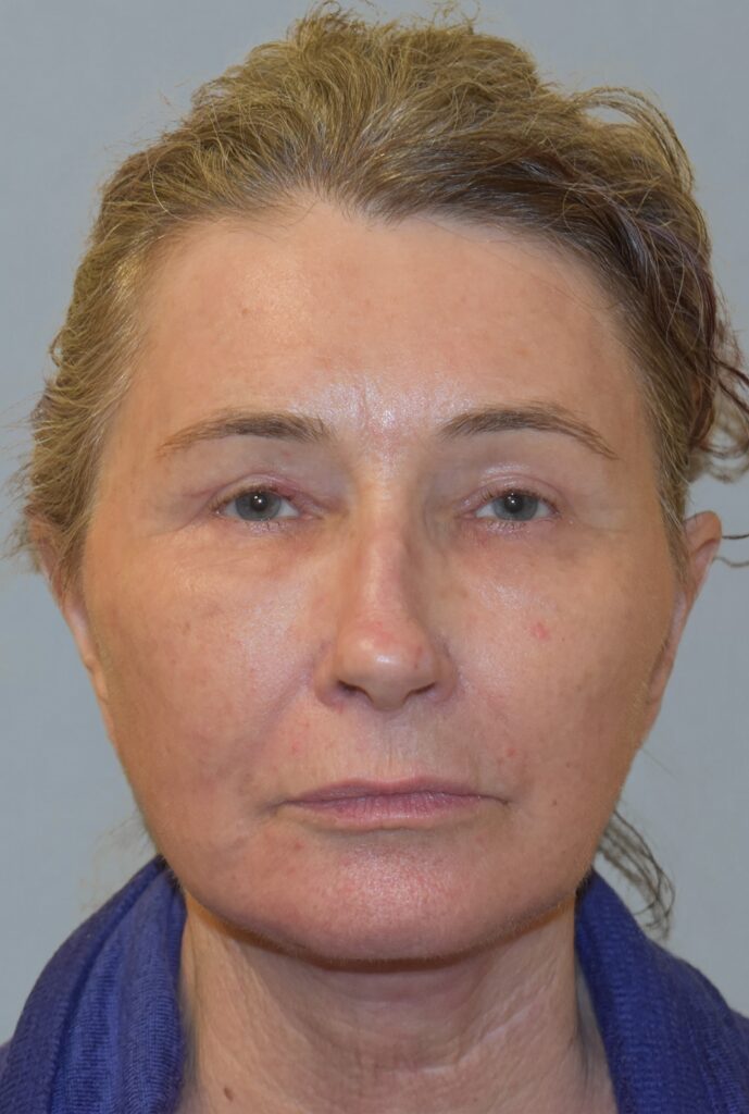 Case FLF-P25 after photo — Dr. Cat, Beverly Hills
