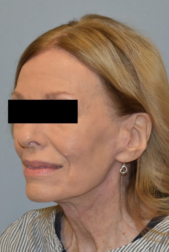 Case FLF-P26 after photo — Dr. Cat, Beverly Hills