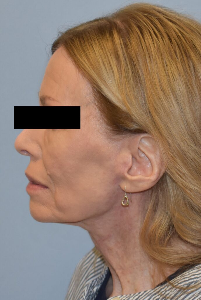 Case FLF-P26 after photo — Dr. Cat, Beverly Hills