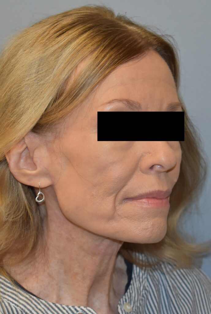 Case FLF-P26 after photo — Dr. Cat, Beverly Hills