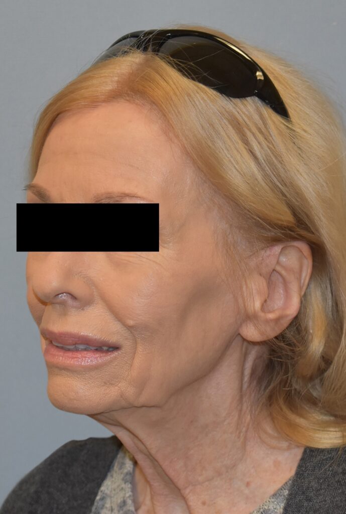 Case FLF-P26 before photo — Dr. Cat, Beverly Hills