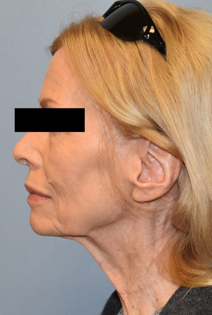 Case FLF-P26 before photo — Dr. Cat, Beverly Hills