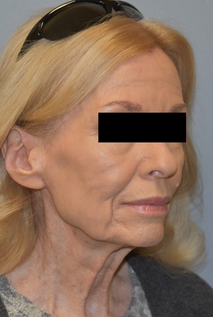 Case FLF-P26 before photo — Dr. Cat, Beverly Hills