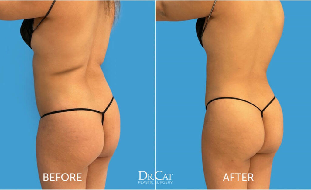 How to sleep after BBL surgery - Dr. Cat Beverly Hills