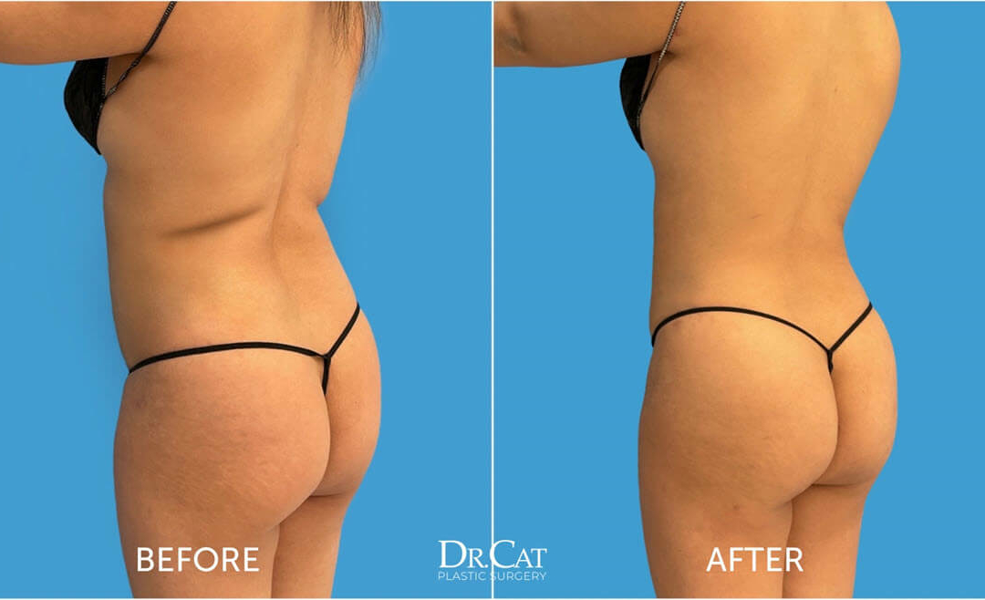How to sleep after BBL surgery - Dr. Cat Beverly Hills