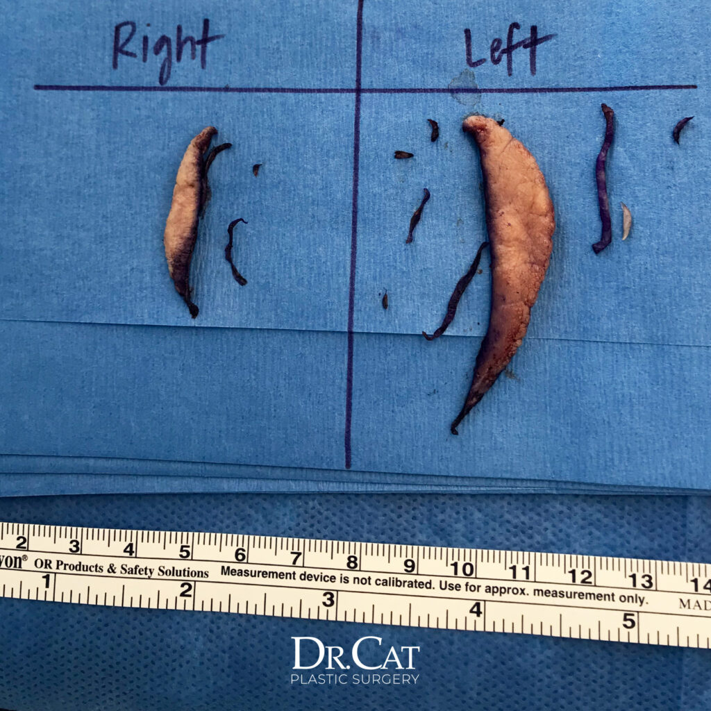 Case LBP-0803 before photo — Dr. Cat, Beverly Hills