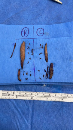 Tissue removed during labiaplasty procedure displayed on surgical cloth.