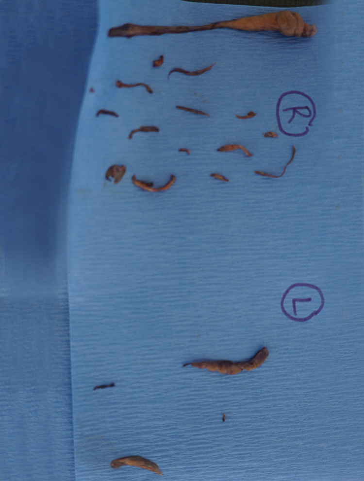 Tissue samples removed and arranged on surgical cloth after labiaplasty procedure.