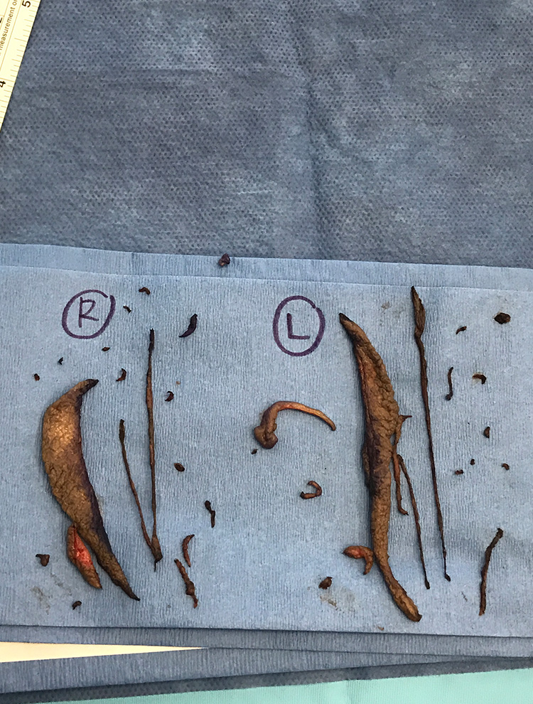 Tissue samples clearly labeled and displayed following labiaplasty surgery.