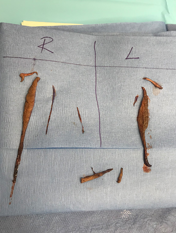Tissue samples clearly labeled and displayed following labiaplasty surgery.