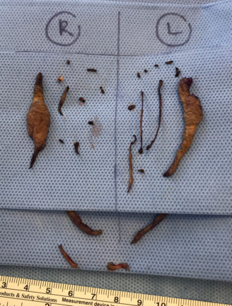 Excised tissue from labiaplasty procedure displayed on surgical cloth with left and right sides labeled.