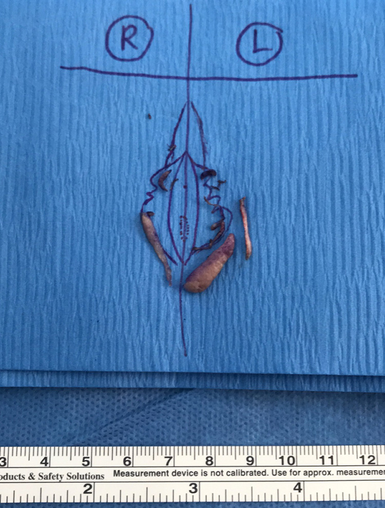 Post-operative tissue removed during labiaplasty, displayed on surgical drape with measurement scale.