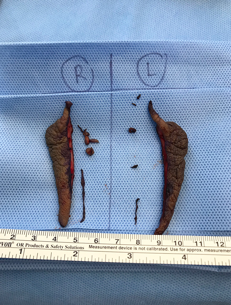 Labiaplasty after photo front view - Dr. Cat Beverly Hills