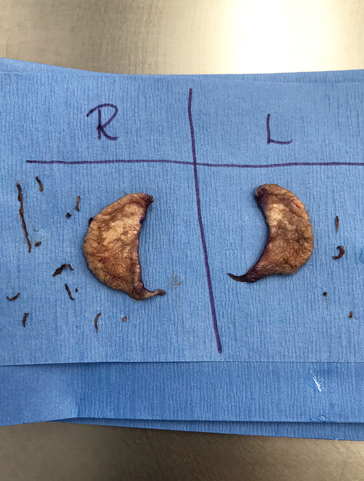 Labia removed during labiaplasty procedure, marked for right and left sides.