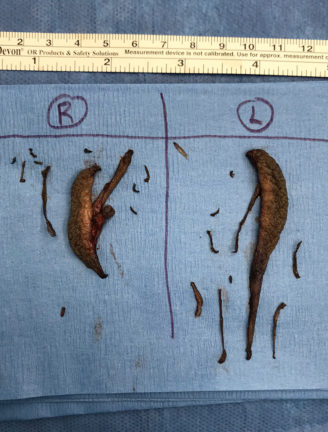 Surgical specimen removed during labiaplasty procedure, displayed clearly labeled on sterile surgical drapes.