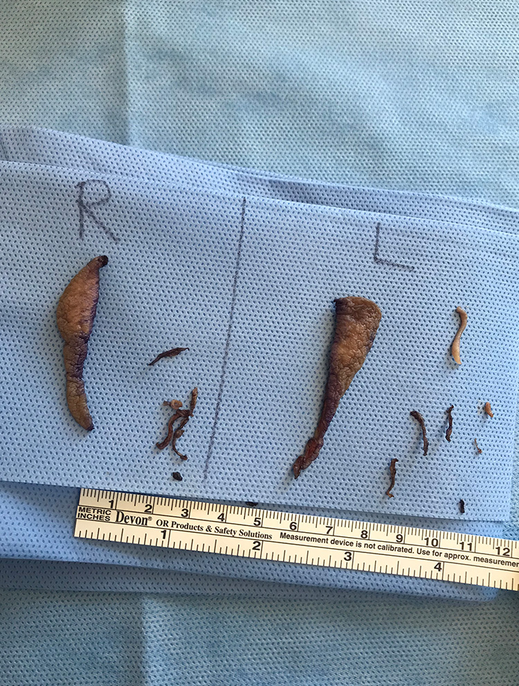 Labiaplasty after photo front view - Dr. Cat Beverly Hills