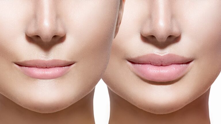 Lip filler treatment and results - Dr. Cat Beverly Hills