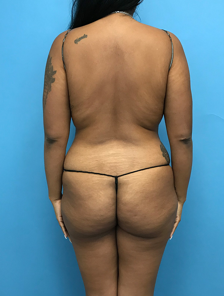 Case LPS-0737 before photo — Dr. Cat, Beverly Hills