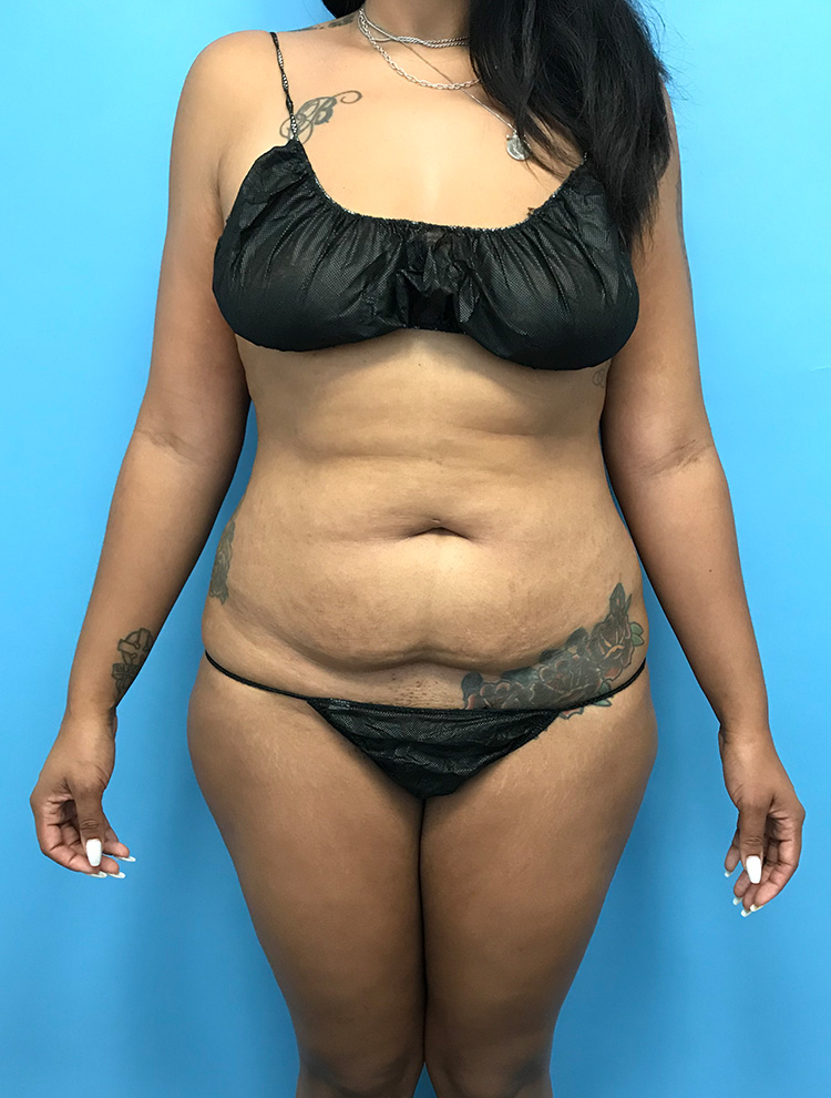 Case LPS-0737 before photo — Dr. Cat, Beverly Hills