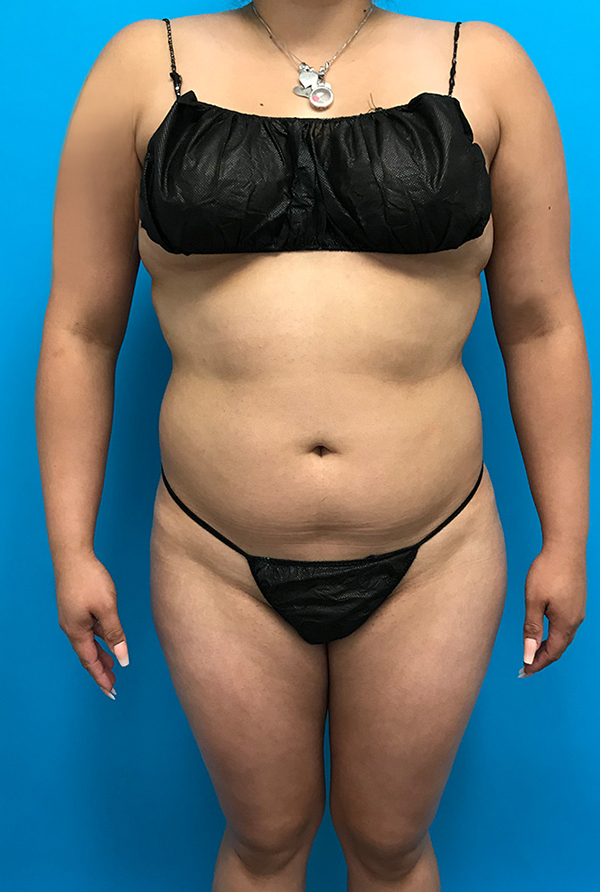 Case LPS-0765 after photo — Dr. Cat, Beverly Hills