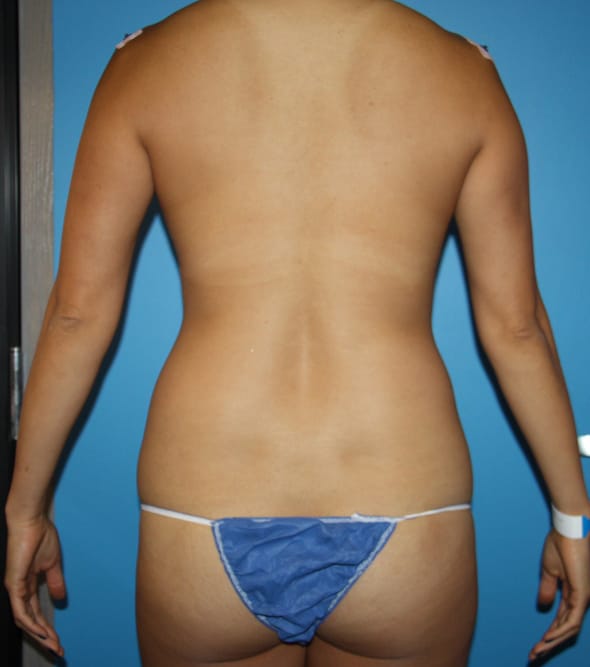 Liposuction before photo - Dr. Cat Beverly Hills